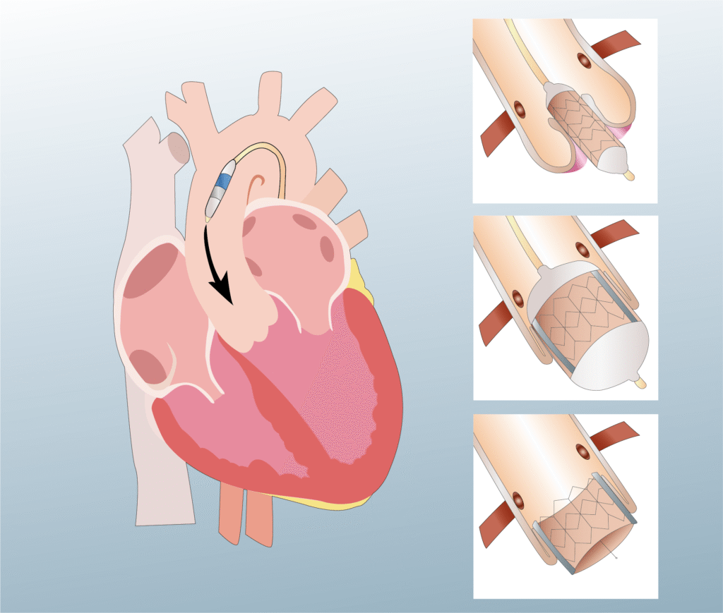 Structural heart procedure - Transcatheter Aortic Valve Implantation