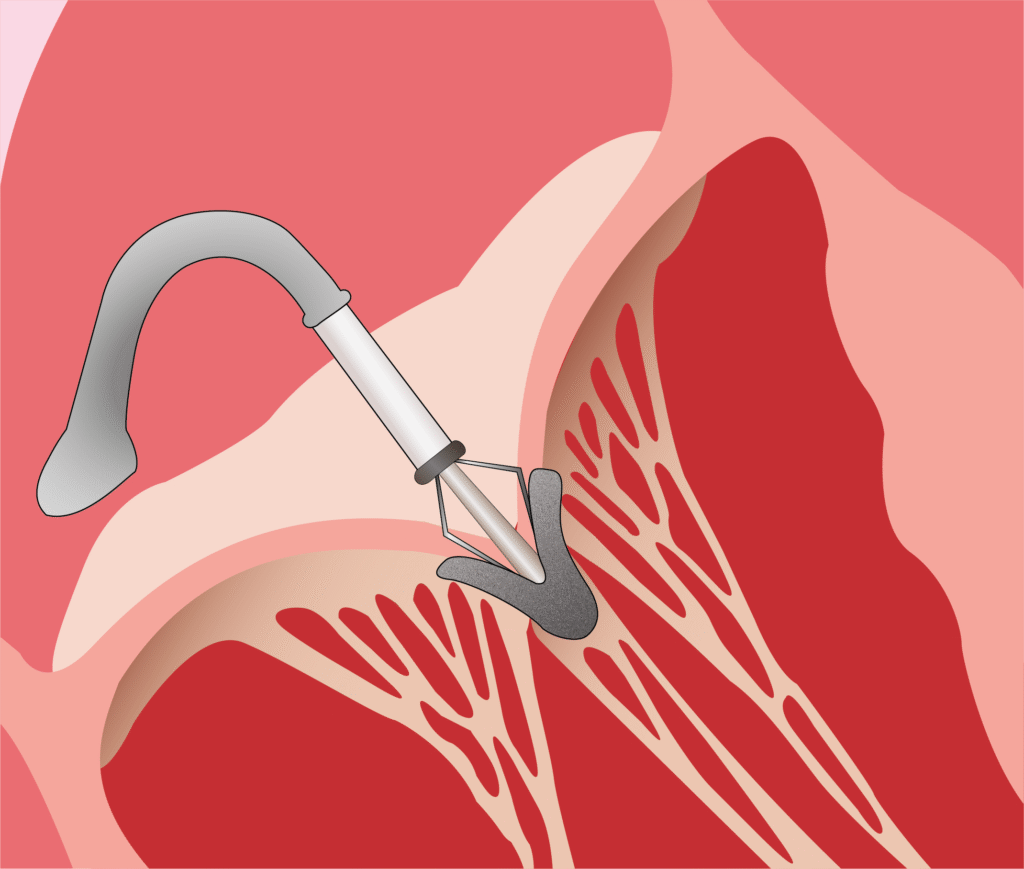 Structural heart procedure - ASD closure