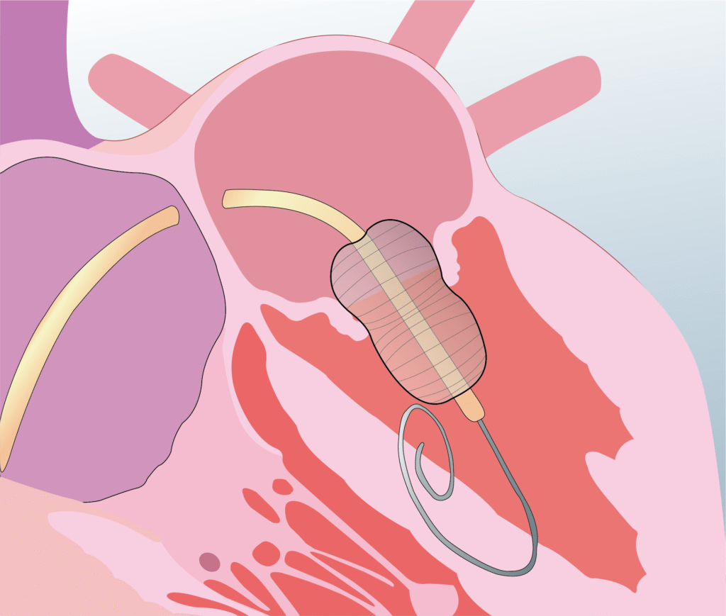 Structural heart procedure - VSD closure