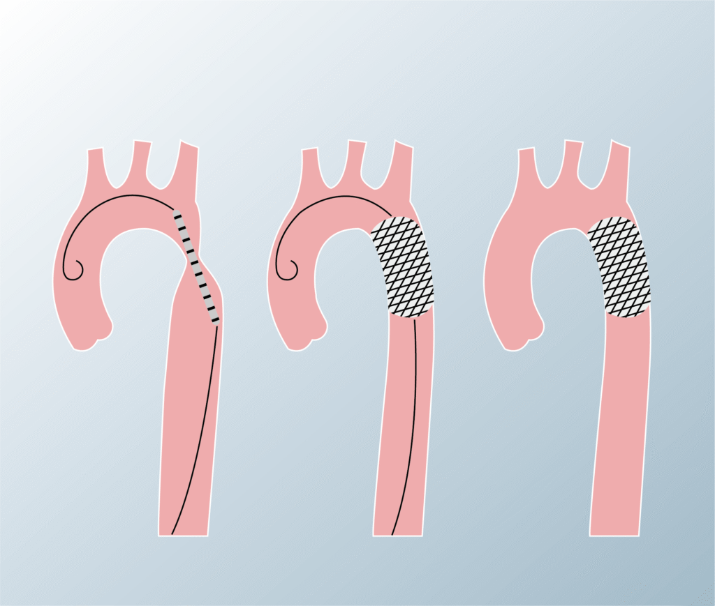 Structural heart procedure - PDA closure
